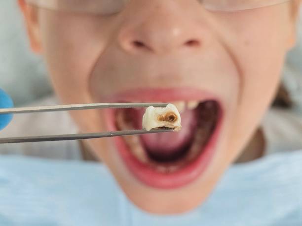 Best Emergency Tooth Extraction in Delevan, NY